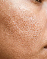 Pores dilatés