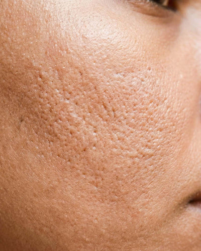 Pores dilatés