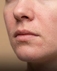 Peau déshydratée et sèche